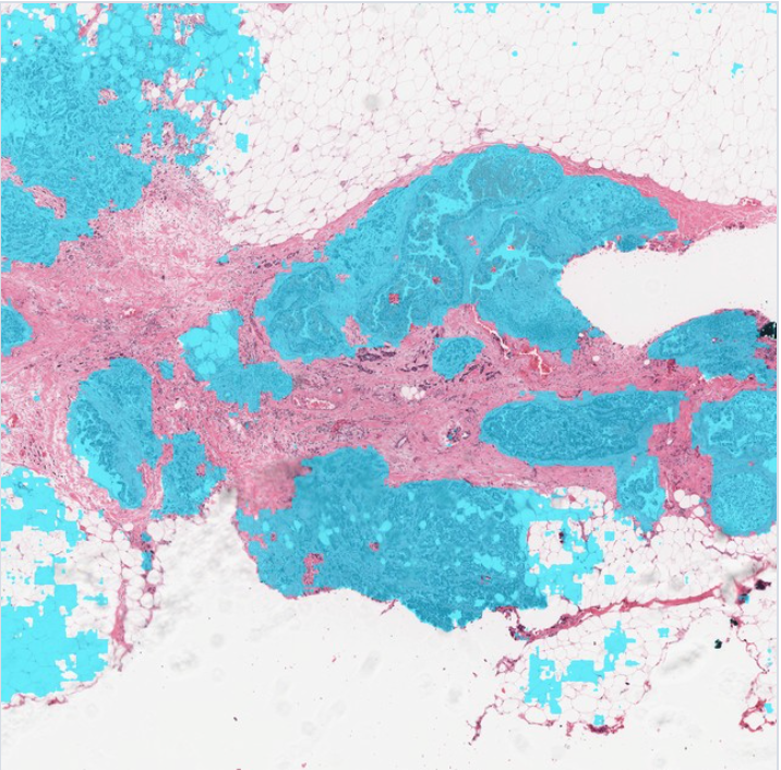 10× Tumor extent mask