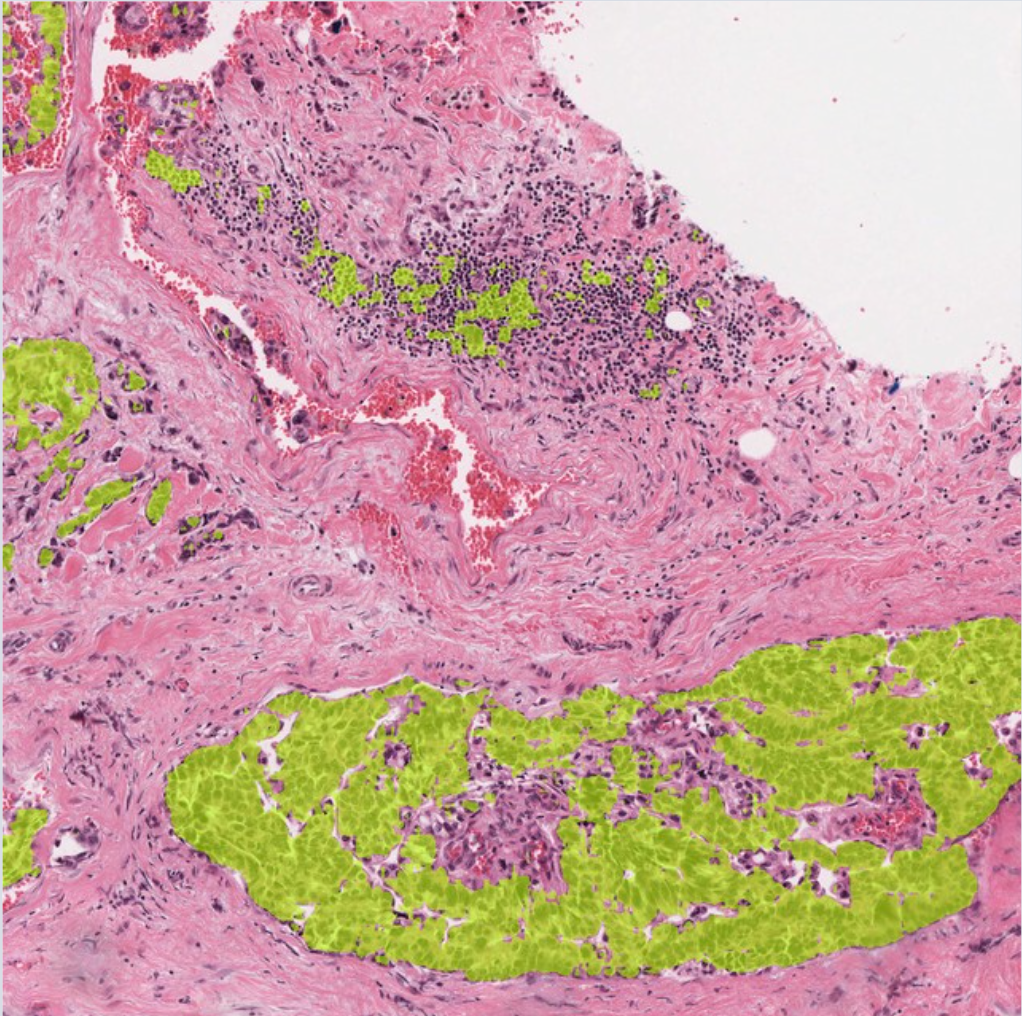 40× Epithelial nests and ducts mask