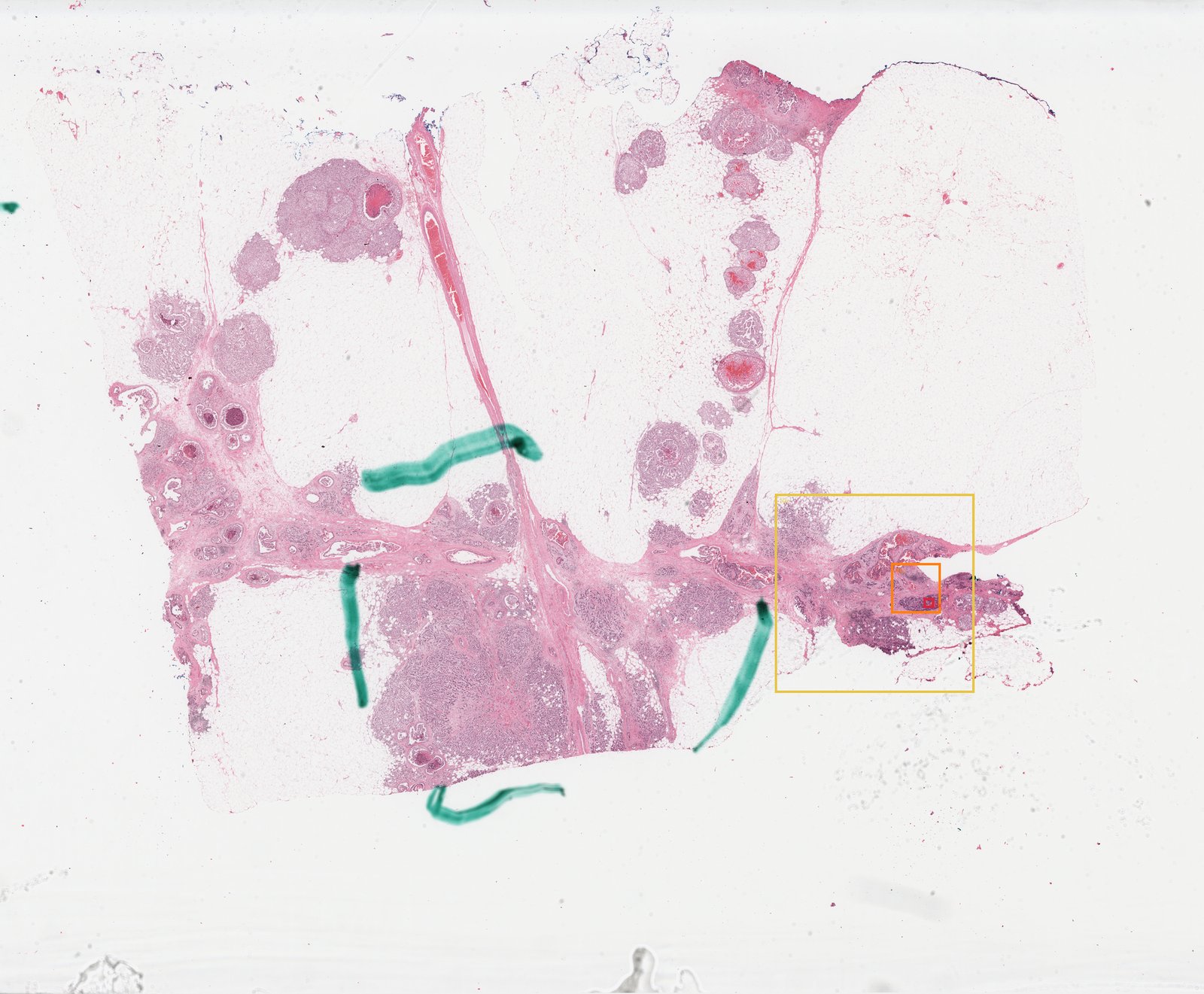 Breast core-biopsy whole slide with the ROI boxed in orange